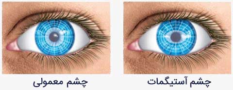 درمان چشم آستیگمات