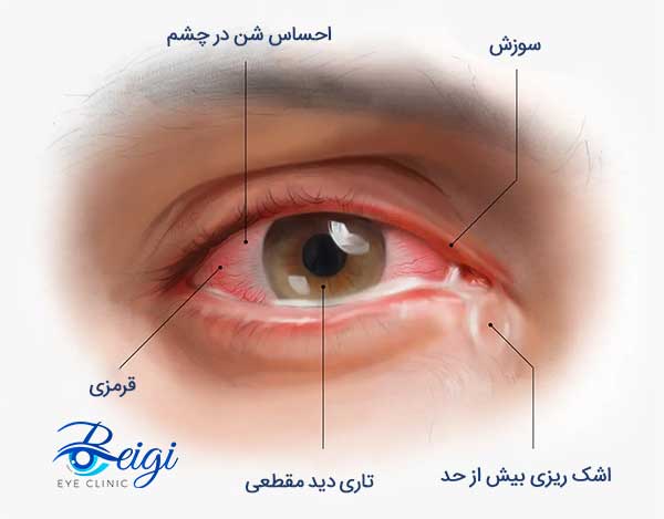 علائم خشکی چشم بعد از لیزیک