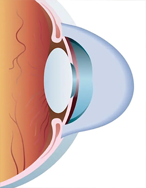 قوز قرنیه چشم چیست؟