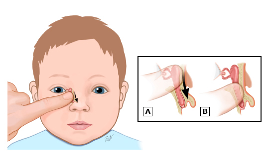 ماساژ چشم نوزاد برای باز شدن مجرای اشکی