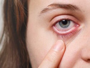 عوارض لیزیک چشم