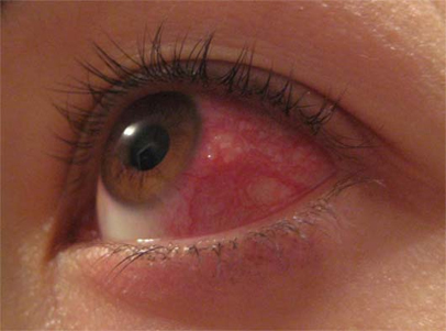 بیماری زونای چشم