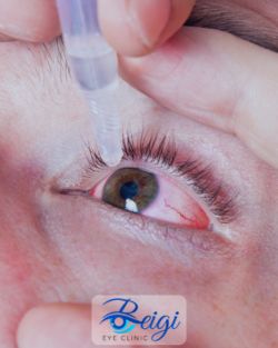 راهکارهای درمان درد و قرمزی چشم بعد از عمل آب مروارید