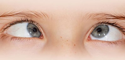 بهترین سن عمل انحراف چشم در کودکان