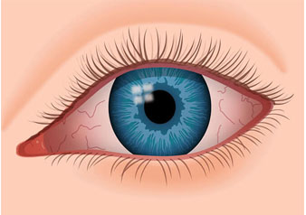 علاج جفاف العين بعد الليزك