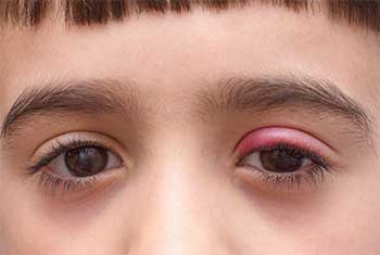 درمان بلفاریت چشم در کودکان