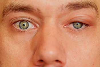 درمان بیماری بلفاریت چشم