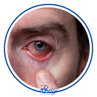 آلرژی چشم در فصل بهار