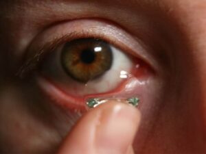 درمان عفونت چشم بر اثر لنز تماسی