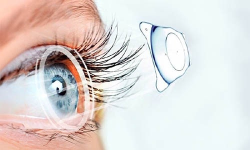 تفاوت کاشت لنز دائمی با لنز تماسی