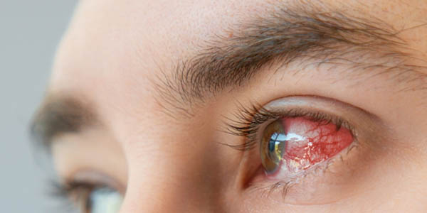 علائم عفونت چشم بعد از لنز