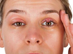 درمان بلفاریت چشم