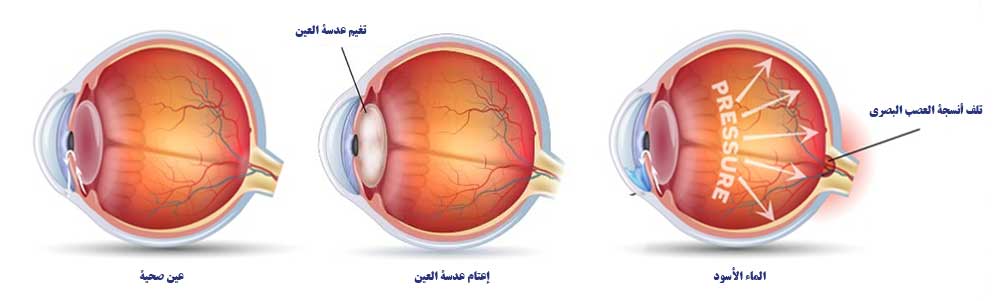 الفرق بين إعتام عدسة العين والماء أسود