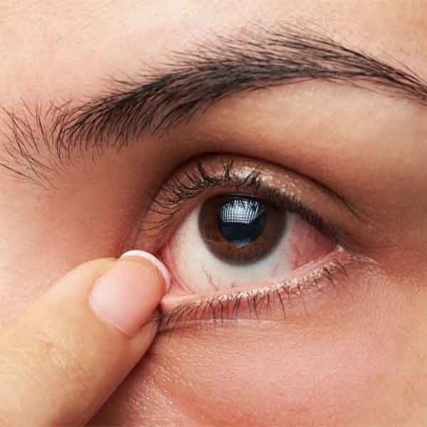 درمان احساس جسم خارجی در چشم