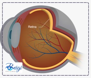 جدا شدگی شبکیه بعد از عمل فمتوکاتاراکت 