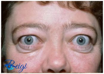 Cause-of-ocular-retraction علت رتراکسیون چشمی