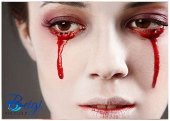 Causes-of-bloody-tears-from-eyes علت اشک خون از چشم