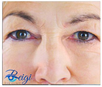 Eyelid-retraction-surgery جراحی رتراکسیون پلک