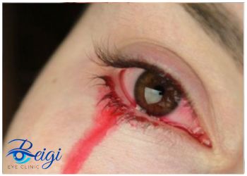 Symptoms-of-bloody-tears علائم بیماری اشک خونی