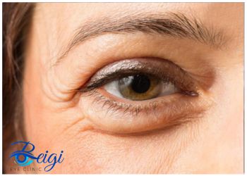 Types-of-hemianopia انواع همی آنوپیا