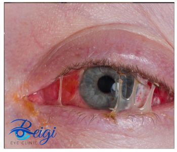 Cause-of-eye-discharge علت تخلیه چشم