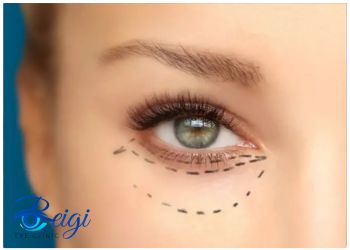Disadvantages-of-surgery-in-lower-eyelid-blepharoplasty معایب جا به جایی در بلفاروپلاستی پلک پایین
