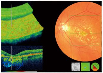 Eye-oct-photo عکس oct چشم