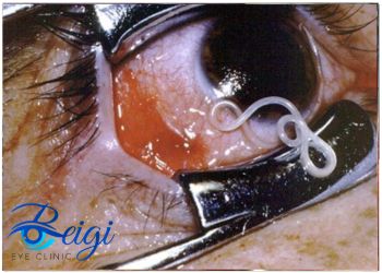 Photo-of-human-eye-parasite عکس انگل چشم انسان