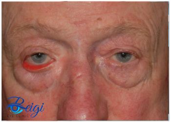 Risk-factors-for-outward-eyelid-rotation عوامل خطر چرخش پلک به سمت خارج