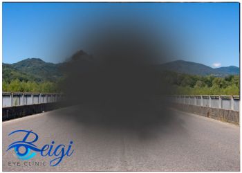 Symptoms-of-age-related-macular-degeneration علائم دژنرسانس ماکولا وابسته به سن