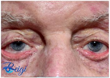 Symptoms-of-ectropion-of-eye علائم اکترپیون چشم