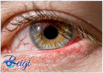 Symptoms-of-scleritis علائم بیماری اسکلریت چشمی