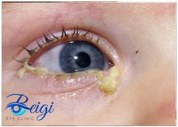 The-dangers-of-sleeping-with-contact-lenses خطرات خوابیدن با لنز چشمی