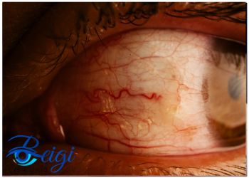 Types-of-age-related-macular-degeneration انواع دژنرسانس وابسته به سن ماکولا