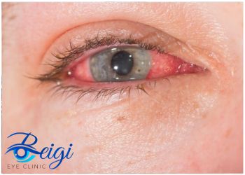 Types-of-scleritis-eye-disease انواع بیماری اسکلریت چشم