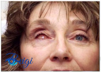 picture-of-evacuated-eye عکس چشم تخلیه شده