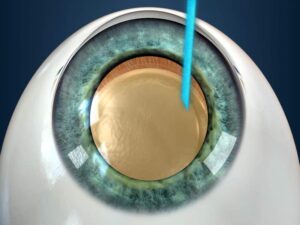 مقایسه فیکوکاتاراکت و فمتوکاتاراکت