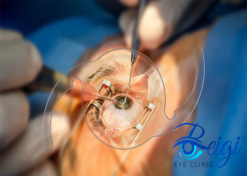 Reasons-why-cataract-surgery-is-contraindicated-in-people علت منع جراحی آب مروارید در افراد