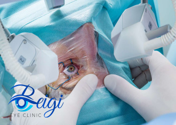 تفاوت هزینه انجام فیکوکاتاراکت و فمتوکاتاراکت
